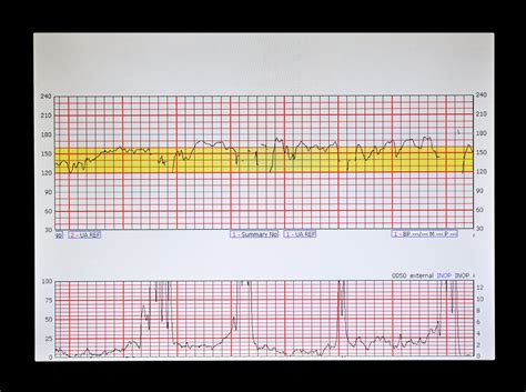 fetal monitoring strips.